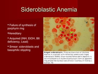 SSiiddeerroobbllaassttiicc AAnneemmiiaa 
 Failure of synthesis of 
porphyrin ring 
Hereditary 
 Acquired (INH, EtOH, B6 
deficiency, Lead) 
 Smear: sideroblasts and 
basophilic stippling 
 