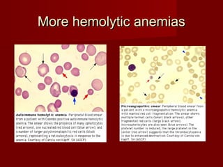 MMoorree hheemmoollyyttiicc aanneemmiiaass 
 
