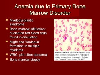 Anemia dduuee ttoo PPrriimmaarryy BBoonnee 
MMaarrrrooww DDiissoorrddeerr 
 MMyyeellooddyyssppllaassttiicc 
ssyynnddrroommee 
 BBoonnee mmaarrrrooww iinnffiillttrraattiioonn:: 
nnuucclleeaatteedd rreedd bblloooodd cceellllss 
ffoouunndd iinn cciirrccuullaattiioonn 
 MMiigghhtt sseeee ““rroouulleeaauuxx”” 
ffoorrmmaattiioonn iinn mmuullttiippllee 
mmyyeelloommaa 
 WWBBCC,, ppllttss oofftteenn aabbnnoorrmmaall 
 BBoonnee mmaarrrrooww bbiiooppssyy 
 