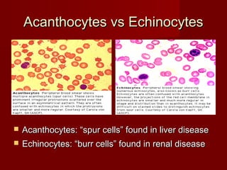 AAccaanntthhooccyytteess vvss EEcchhiinnooccyytteess 
 AAccaanntthhooccyytteess:: ““ssppuurr cceellllss”” ffoouunndd iinn lliivveerr ddiisseeaassee 
 EEcchhiinnooccyytteess:: ““bbuurrrr cceellllss”” ffoouunndd iinn rreennaall ddiisseeaassee 
 