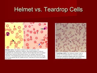 HHeellmmeett vvss.. TTeeaarrddrroopp CCeellllss 
 