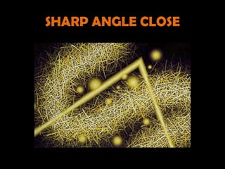 SHARP ANGLE CLOSE
 