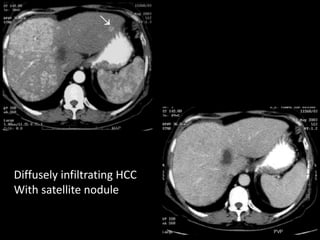 Imaging of Malignant Liver Lesions | PPTX