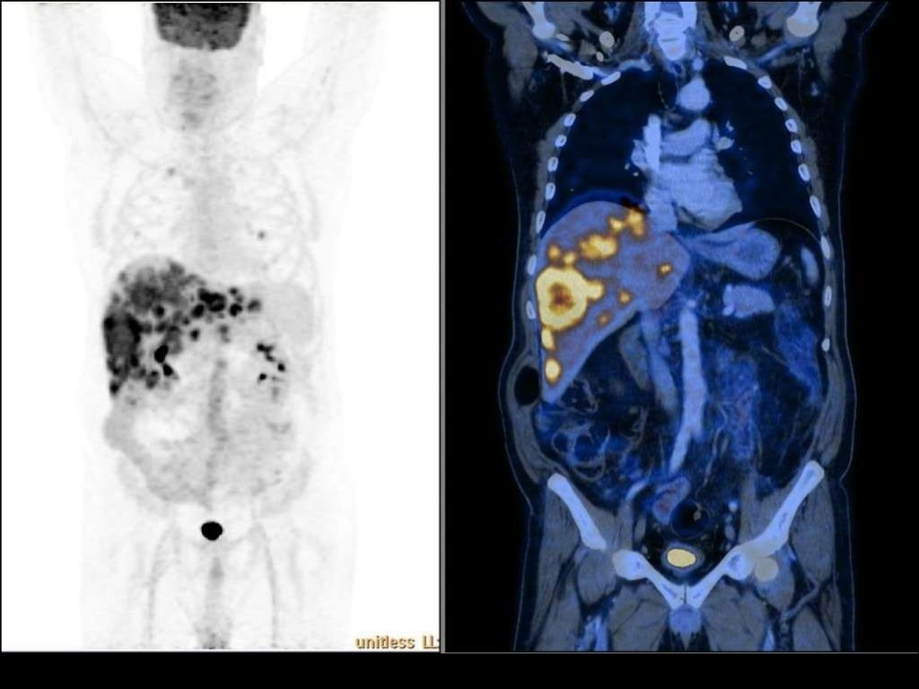 Imaging of Malignant Liver Lesions