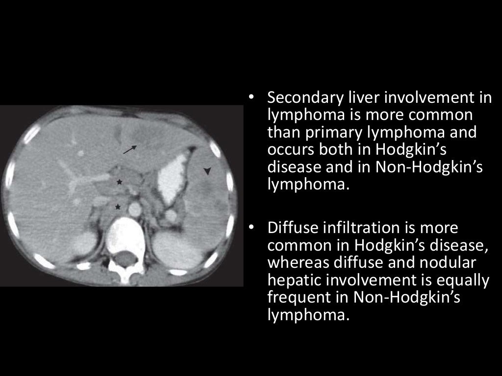 Imaging of Malignant Liver Lesions