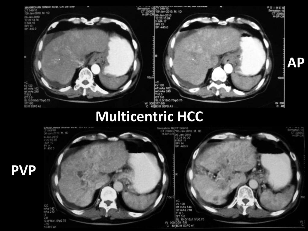 Imaging of Malignant Liver Lesions