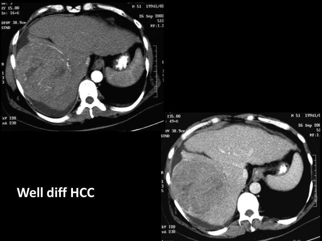 Imaging of Malignant Liver Lesions