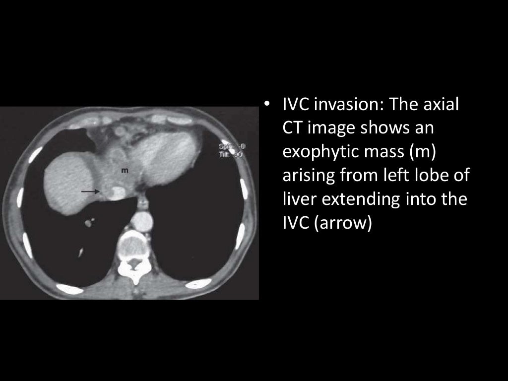 Imaging of Malignant Liver Lesions