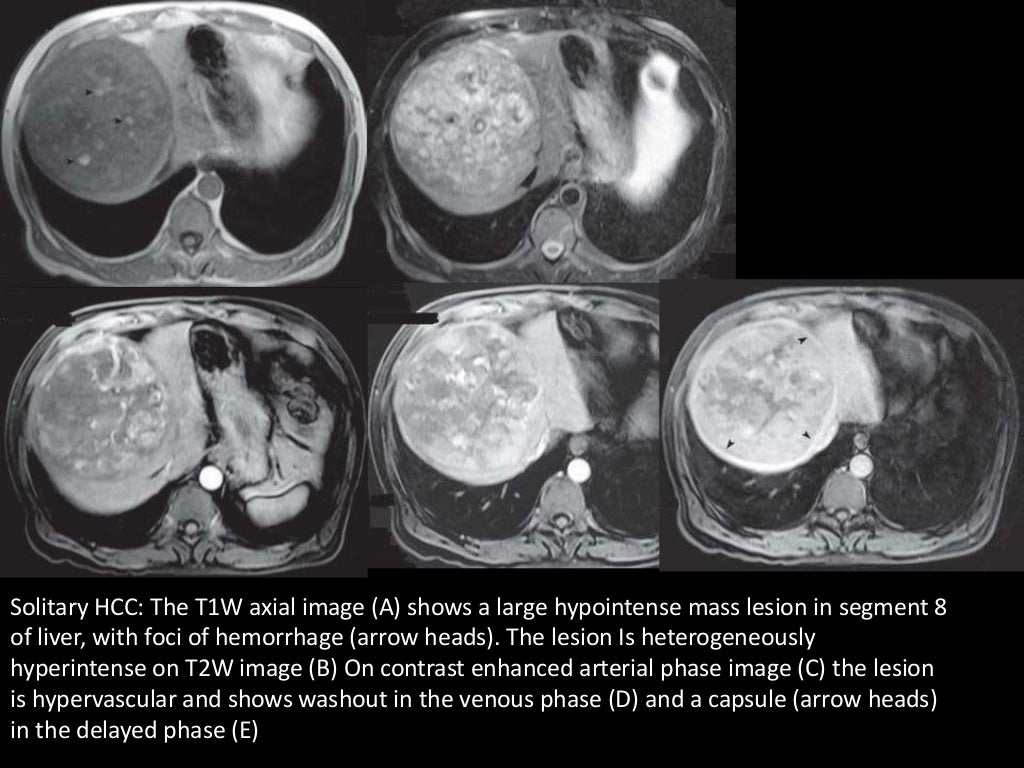 Imaging of Malignant Liver Lesions