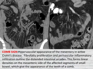 IBD AND ABDOMINAL TB-ROLE OF IMAGING | PPTX