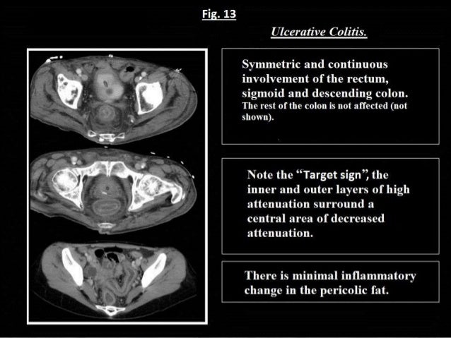 Crohn S And Colitis Ring Crohn S And Colitis Ring