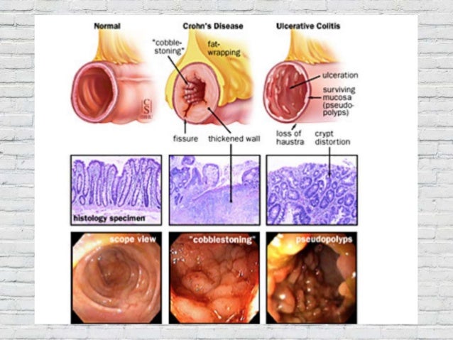 the causes and main features of crohns disease Crohn’s disease (cd), an skip to main content home news a synonymous variant in irgm alters a binding site for mir-196 and causes deregulation of irgm. the causes and main features of crohns disease Crohn’s disease (cd), an skip to main content home news a synonymous variant in irgm alters a binding site for mir-196 and causes deregulation of irgm.