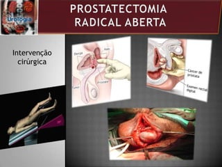 Intervenção
cirúrgica
 