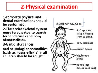 Approach to a child with Rickets | PPTX