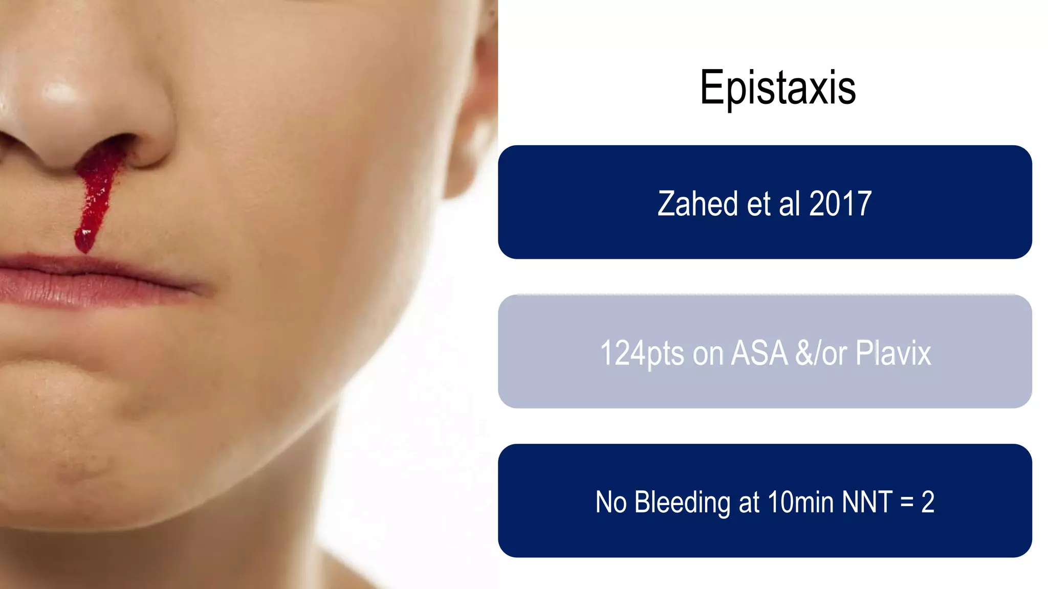 Epistaxis
Zahed et al 2017
124pts on ASA &/or Plavix
No Bleeding at 10min NNT = 2
 