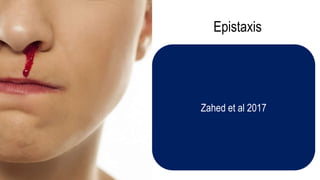 Epistaxis
Zahed et al 2017
 