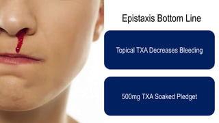 Epistaxis Bottom Line
Topical TXA Decreases Bleeding
500mg TXA Soaked Pledget
 