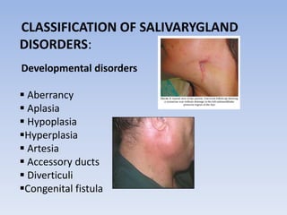 CLASSIFICATION OF SALIVARYGLAND
DISORDERS:
Developmental disorders
 Aberrancy
 Aplasia
 Hypoplasia
Hyperplasia
 Artesia
 Accessory ducts
 Diverticuli
Congenital fistula
 