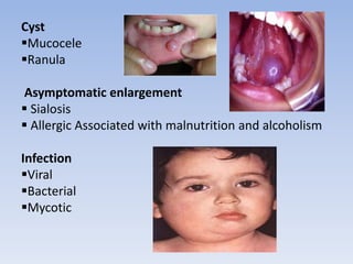 Cyst
Mucocele
Ranula
Asymptomatic enlargement
 Sialosis
 Allergic Associated with malnutrition and alcoholism
Infection
Viral
Bacterial
Mycotic
 