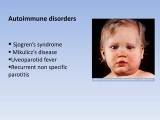 Autoimmune disorders
 Sjogren’s syndrome
 Mikulicz’s disease
Uveoparotid fever
Recurrent non specific
parotitis
 