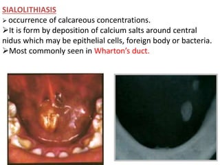 SIALOLITHIASIS
 occurrence of calcareous concentrations.
It is form by deposition of calcium salts around central
nidus which may be epithelial cells, foreign body or bacteria.
Most commonly seen in Wharton’s duct.
 