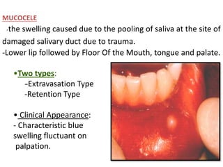 MUCOCELE
-the swelling caused due to the pooling of saliva at the site of
damaged salivary duct due to trauma.
-Lower lip followed by Floor Of the Mouth, tongue and palate.
•Two types:
-Extravasation Type
-Retention Type
• Clinical Appearance:
- Characteristic blue
swelling fluctuant on
palpation.
 