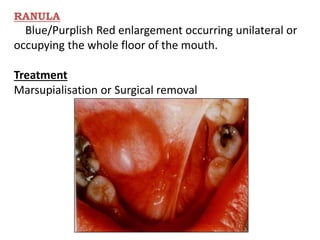 RANULA
Blue/Purplish Red enlargement occurring unilateral or
occupying the whole floor of the mouth.
Treatment
Marsupialisation or Surgical removal
 