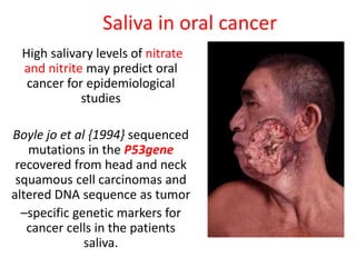 Saliva in oral cancer
High salivary levels of nitrate
and nitrite may predict oral
cancer for epidemiological
studies
Boyle jo et al {1994} sequenced
mutations in the P53gene
recovered from head and neck
squamous cell carcinomas and
altered DNA sequence as tumor
–specific genetic markers for
cancer cells in the patients
saliva.
 