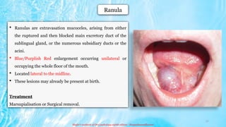 Midline Ranula saliva and salivary gland DETAILS .pptx