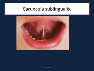 Caruncula sublingualis.
DrLaila Amin
 