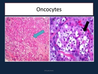 Oncocytes
DrLaila Amin
 