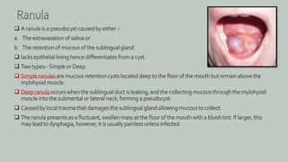  A ranula is a pseudocyst caused by either :-
a. The extravasation of saliva or
b. The retention of mucous of the sublingual gland
 lacks epithelial lining hence differentiates from a cyst.
 Two types:-Simple or Deep.
 Simple ranulas are mucous retention cysts located deep to the floor of the mouth but remain above the
mylohyoid muscle.
 Deep ranula occurs when the sublingual duct is leaking, and the collecting mucous through the mylohyoid
muscle into the submental or lateral neck, forming a pseudocyst.
 Caused by local trauma that damages the sublingual gland allowing mucous to collect.
 The ranula presents as a fluctuant, swollen mass at the floor of the mouth with a bluish tint. If larger, this
may lead to dysphagia, however, it is usually painless unless infected.
Ranula
 