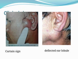 Deflected Sign Salivary Gland tumours benign and malignant.pptx