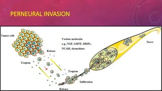 Parthenia Invasive Salivary gland disease | PPTX
