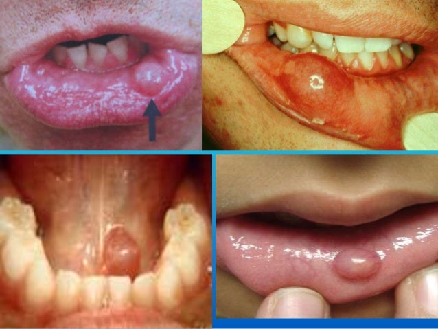 Mouth Problems Slideshow: Pictures of Mouth Sores, Oral ...