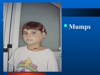 salivary gland diseases..power point presentation | PPT