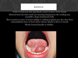 Midline Ranula Salivary gland disorders final | PPT