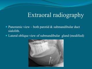 Extraoral radiography
 Panoramic view – both parotid & submandibular duct
sialolith.
 Lateral oblique view of submandibular gland (modified)
 
