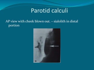 Parotid calculi
AP view with cheek blown out. – sialolith in distal
portion
 