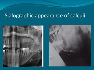 Sialographic appearance of calculi
 