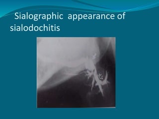Sialographic appearance of
sialodochitis
 