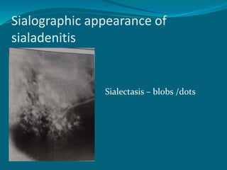 Sialographic appearance of
sialadenitis
Sialectasis – blobs /dots
 