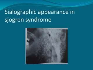 Sialographic appearance in
sjogren syndrome
 