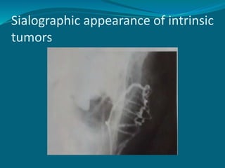Sialographic appearance of intrinsic
tumors
 