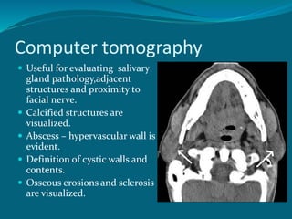 Computer tomography
 Useful for evaluating salivary
gland pathology,adjacent
structures and proximity to
facial nerve.
 Calcified structures are
visualized.
 Abscess – hypervascular wall is
evident.
 Definition of cystic walls and
contents.
 Osseous erosions and sclerosis
are visualized.
 