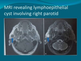 MRI revealing lymphoepithelial
cyst involving right parotid
 