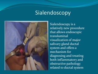 Sialendoscopy
Sialendoscopy is a
relatively new procedure
that allows endoscopic
transluminal
visualization of major
salivary gland ductal
system and offers a
mechanism for
diagnosing and treating
both inflammatory and
obstructive pathology
related to ductal system
 
