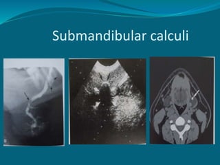 Submandibular calculi
 