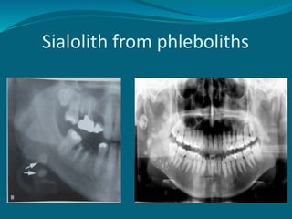 Sialolith from phleboliths
 