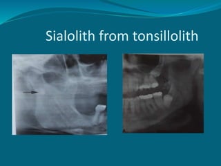 Sialolith from tonsillolith
 